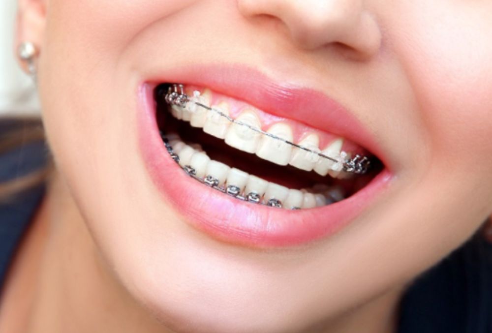 Ceramic braces placed during Brace Yourself treatment