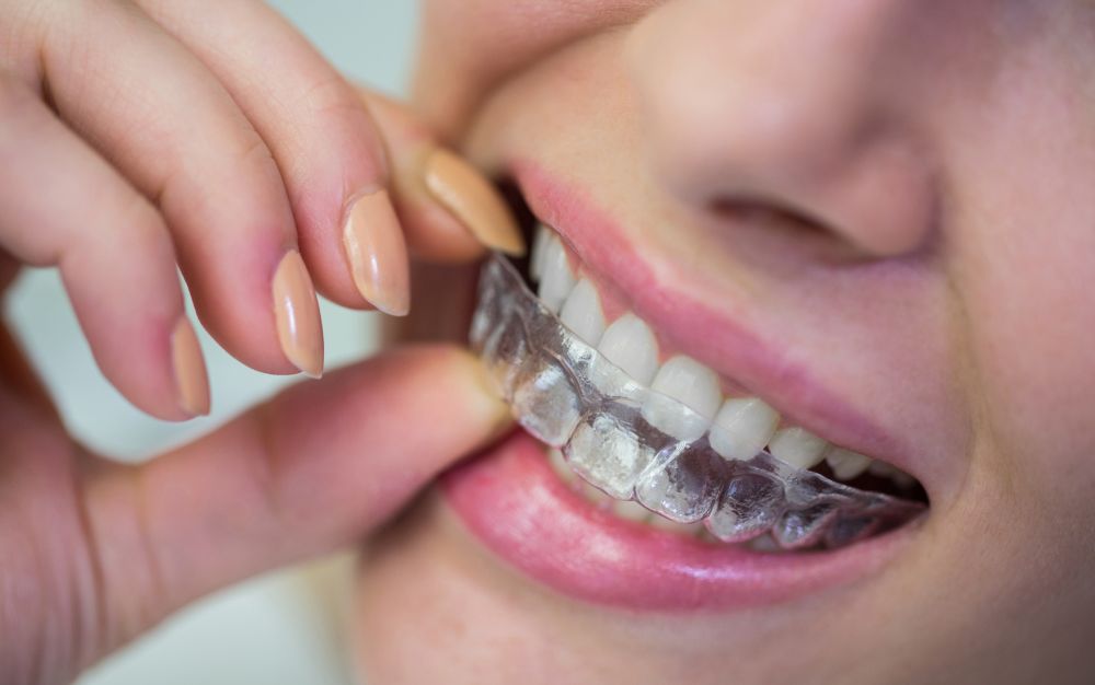 Dental Retainer