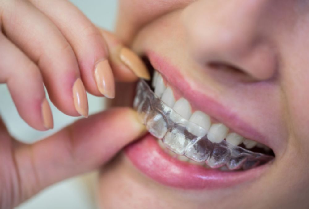  Invisalign placed during Brace Yourself treatment