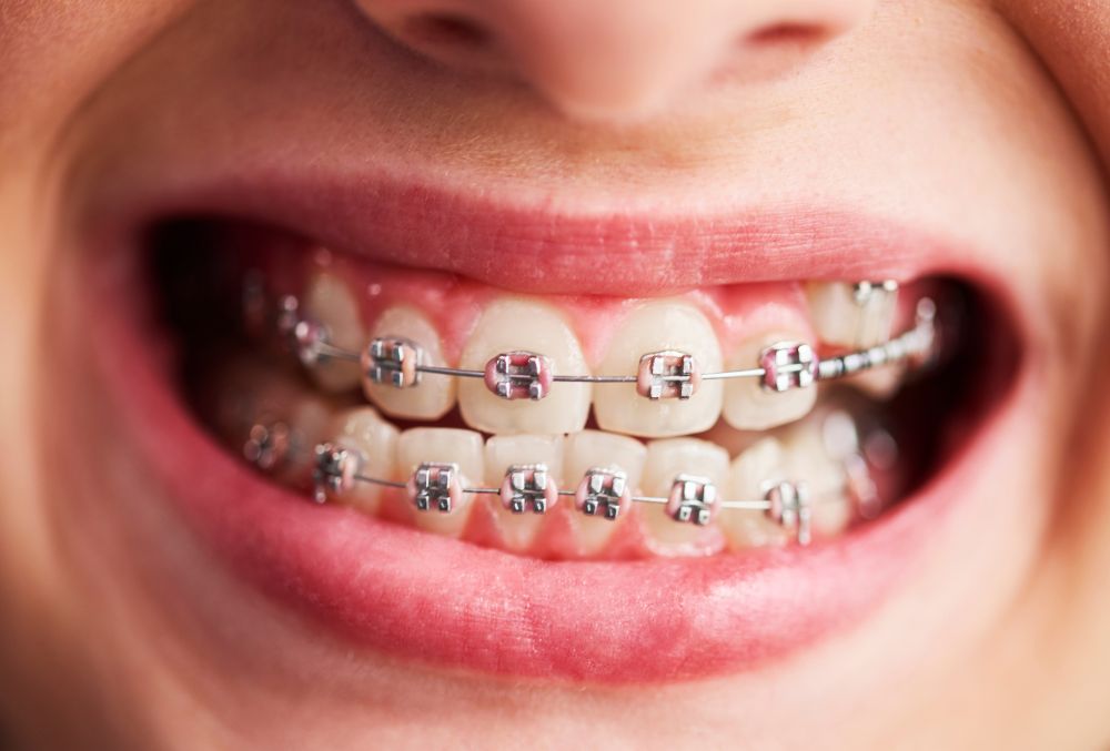 Metal braces placed during Brace Yourself treatment