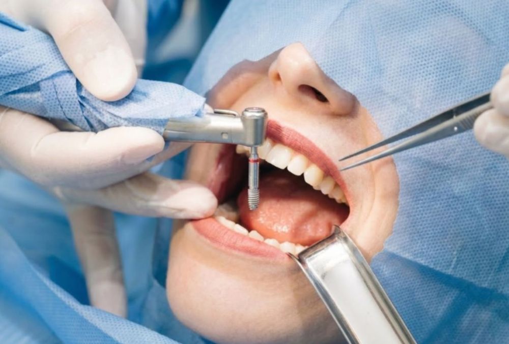 Oral surgery for wisdom tooth removal