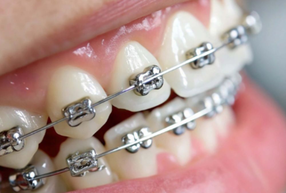 Self-ligating braces placed during Brace Yourself treatment