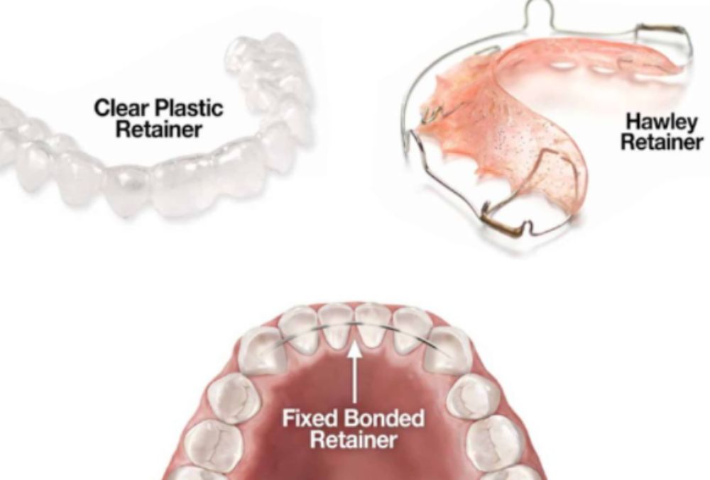 Types of dental retainers based on your needs