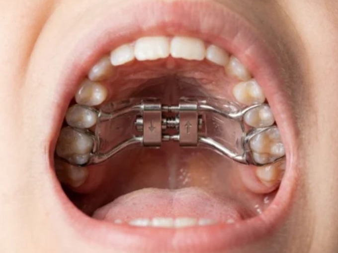 Surgery for underbite treatment